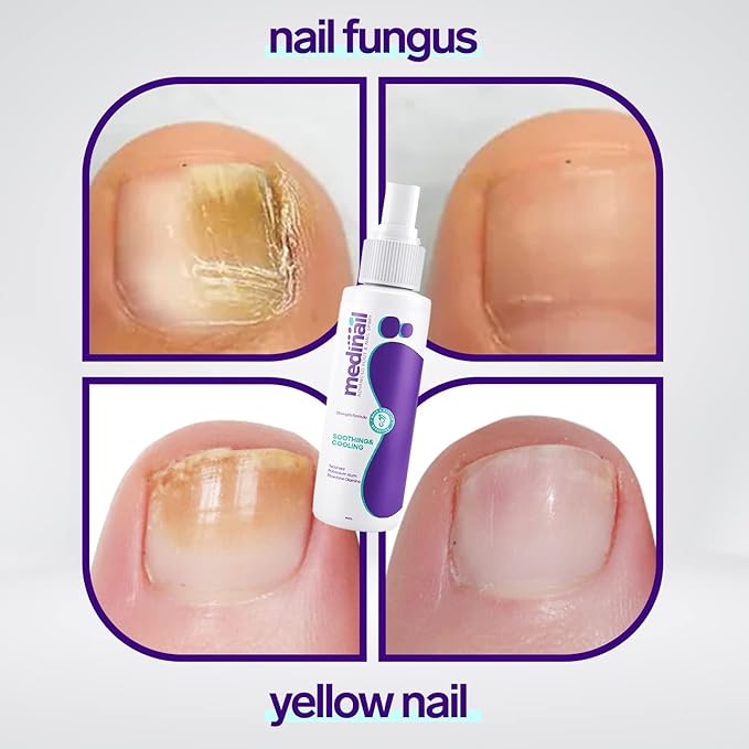 Nail Fungus Remover Spray