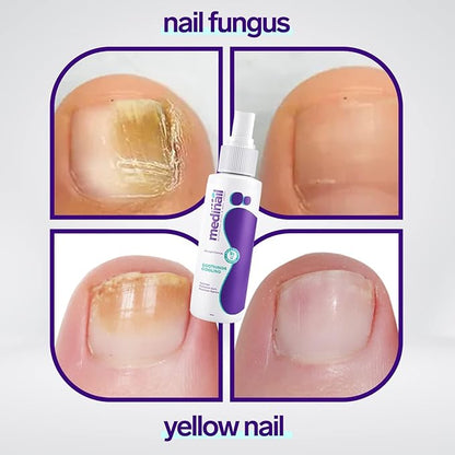 Nail Fungus Remover Spray